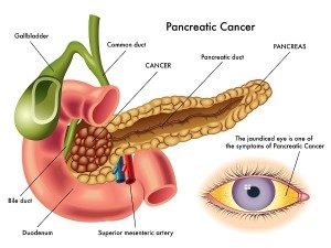 Pancreatic-Cancer