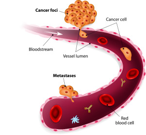 Cancer cell squeezes through blood vessel during Metastases