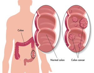 COLORECTAL CANCER