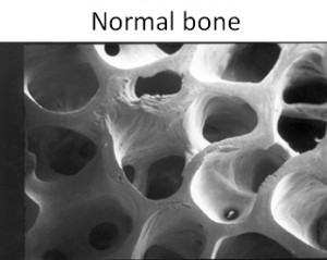 normal-bone